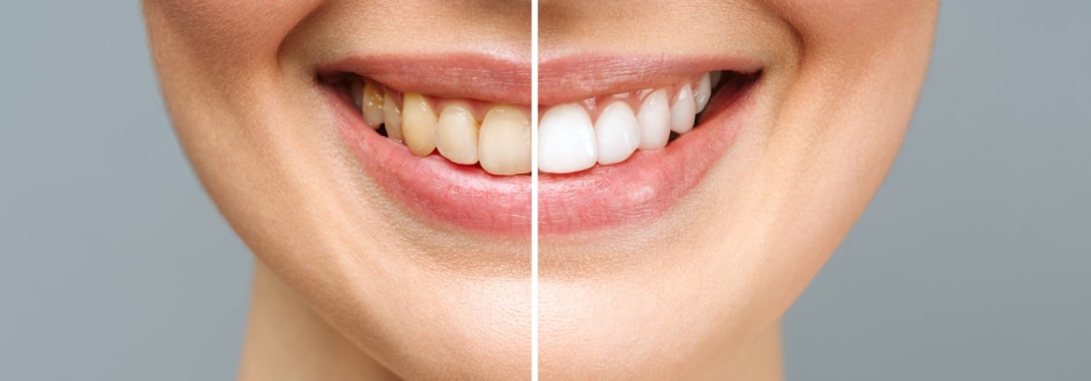 woman-teeth-before-after-whitening-white-background-dental-clinic-patient-image-symbolizes
